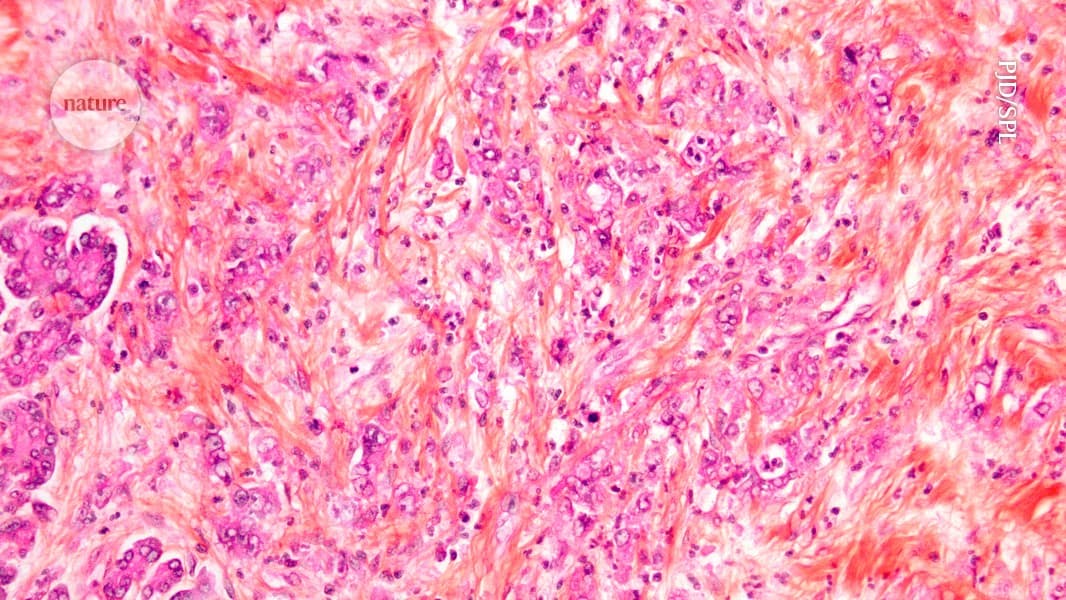 New drugs take aim at one of cancer’s deadliest...