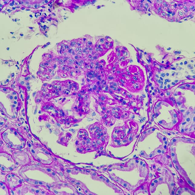 STAT+: 5 years after lupus breakthrough, CAR-T is...